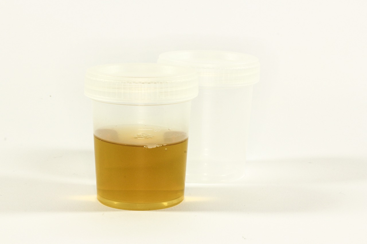 Light Yellow Colour Urine Is Better Than White Colour Urine