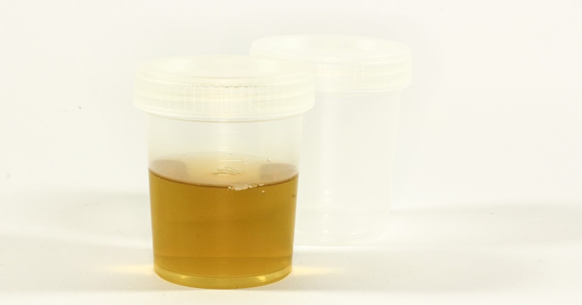 Light Yellow Colour Urine Is Better Than White Colour Urine