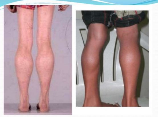 Importance Of Dmd Bmd Duchenne Becker Muscular Dystrophy Diagnosis