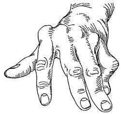 Jammed or Broken Finger Help: Finger Arthritis