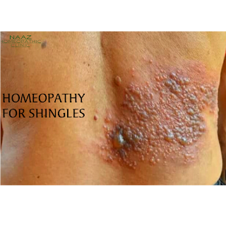 Homeopathy for Herpes zoster ( Shingles )