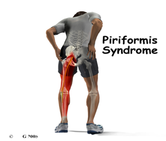 Physical Therapy News : Sciatica? Herniated Disk? Similar Symptoms 