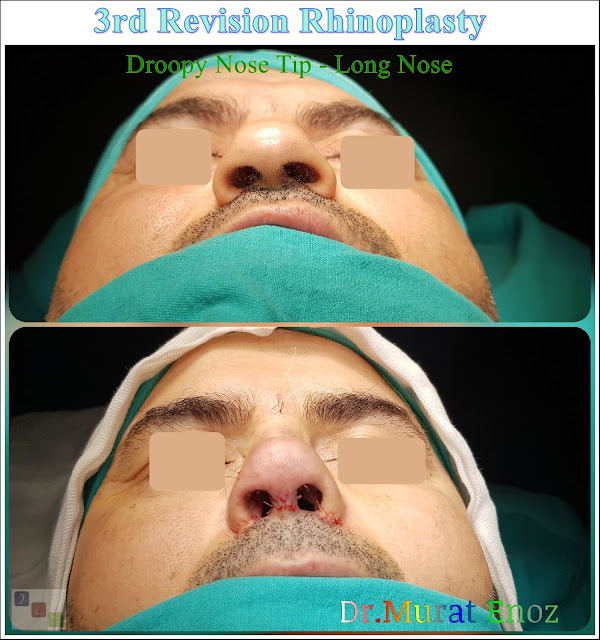 3rd Revision Rhinoplasty - Droopy Nose Tip - Tertiary Nose Job For Men