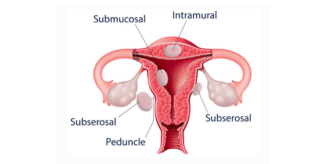 A diagram of uterine fibroids