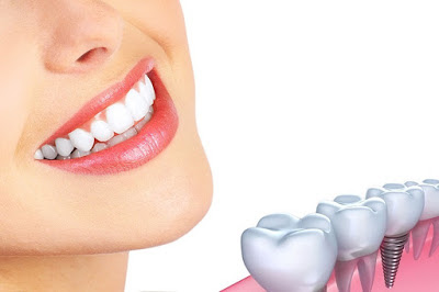 https://www.fullmouthimplant.com/implant-services/full-mouth-dental-implants.html