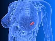 Absceso en las glándulas mamarias: Causas, Sintomas y Tratamientos Absceso en las glándulas mamarias: Causas, Sintomas y Tratamientos