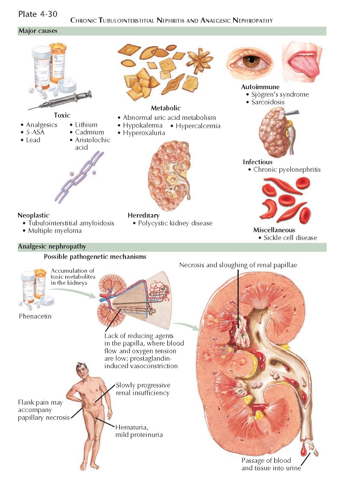 CHRONIC TUBULOINTERSTITIAL NEPHRITIS pediagenosis