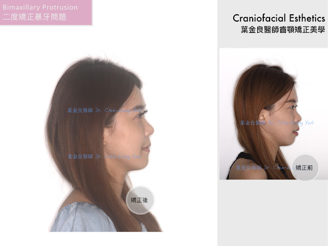 牙齒內傾！矯正後發生內傾！怎麼辦？