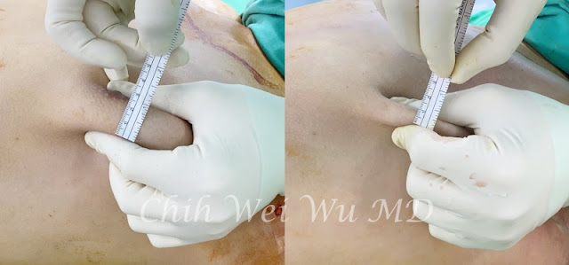 男性女乳手術抽脂與乳腺切除立即效果，左為術前，右為立即術後