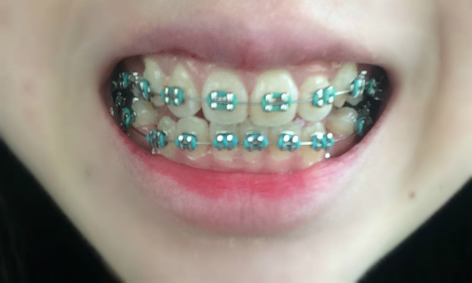 Braces FollowUp!