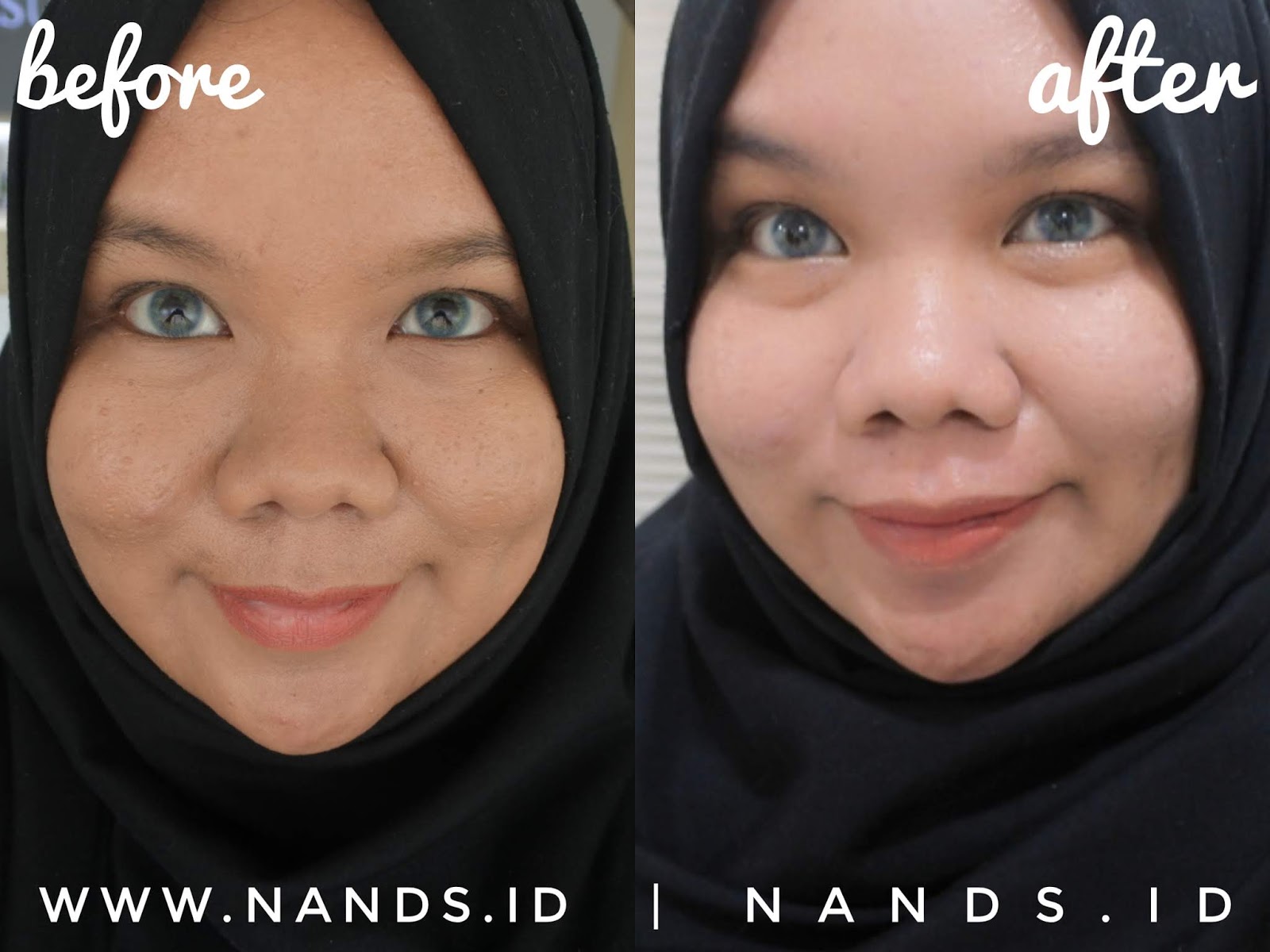 Facial Blue Light Di Kusuma Beauty Clinic Berasa Cantik Seketika Nand S By Anisa Nurrananda