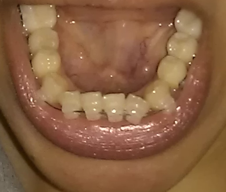 My Damon Clear Braces Day 21 first wire change!!