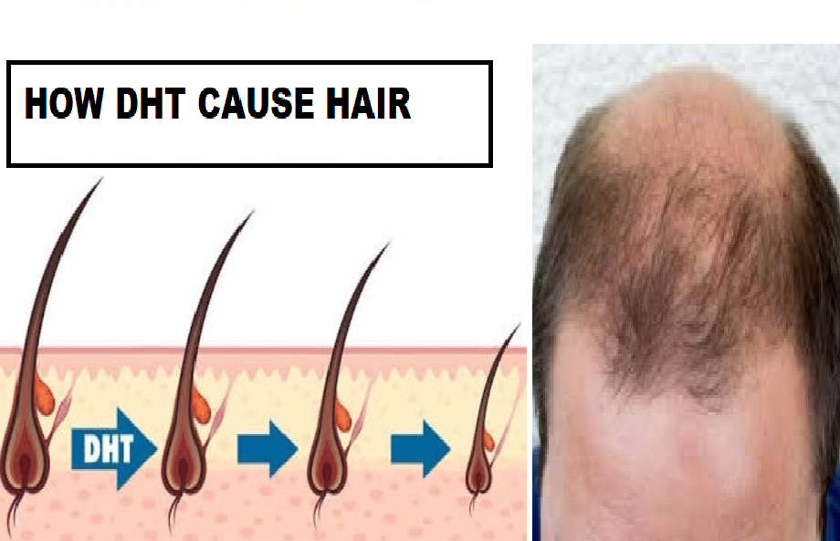 DHT क्या है? DHT बालों के झड़ने का कारण कैसे बनता है? What is DHT? How
