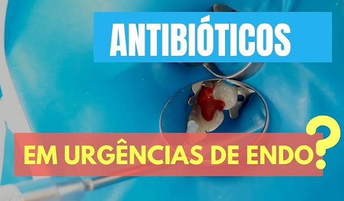 ENDODONTIA: Antibiótico em casos de urgência endodôntica - Fernanda Signoretti, Ph.D