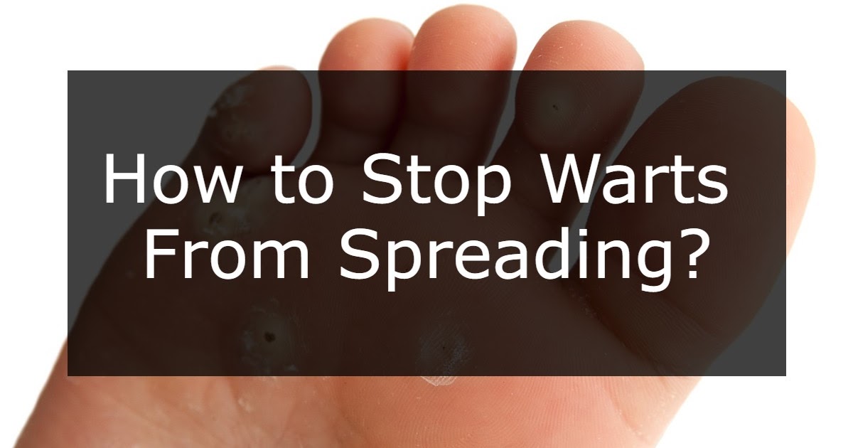 How to Stop Warts From Spreading? Moles, Warts & Skin Tags Removal