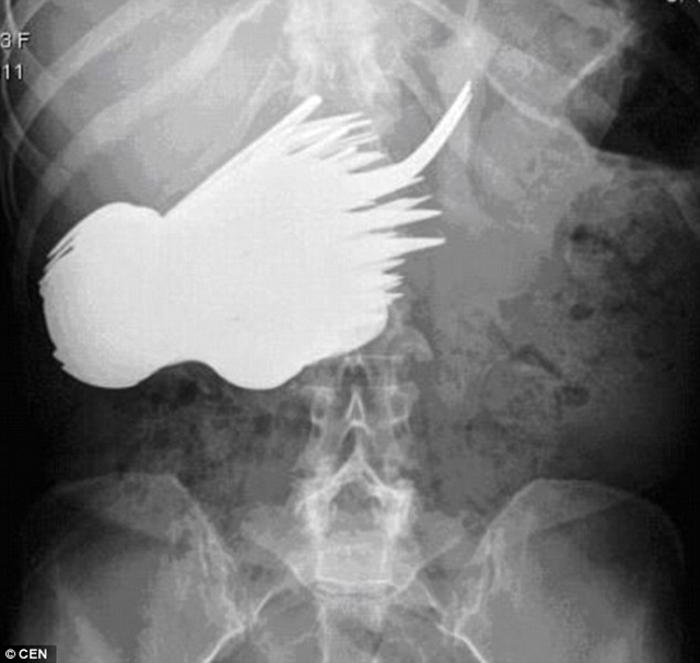 25 Shocking X-Ray Images That You Won't Believe Haven't Been Phot...