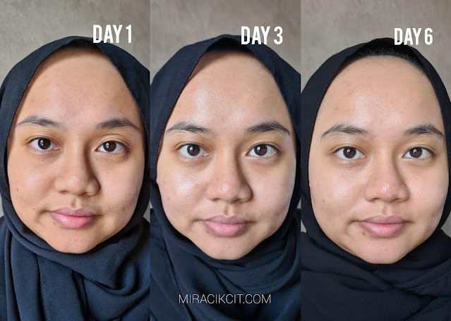 Skin result after using FOREO UFO for a week
