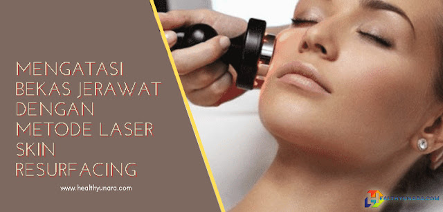 Mengatasi Bekas Jerawat Dengan Metode Laser Skin Resurfacing Mengatasi Bekas Jerawat Dengan Metode Laser Skin Resurfacing