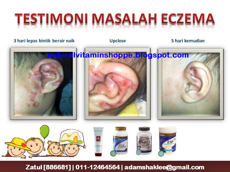 Natural Vitamin Shoppe Eczema Pulih Dengan Produk Shaklee