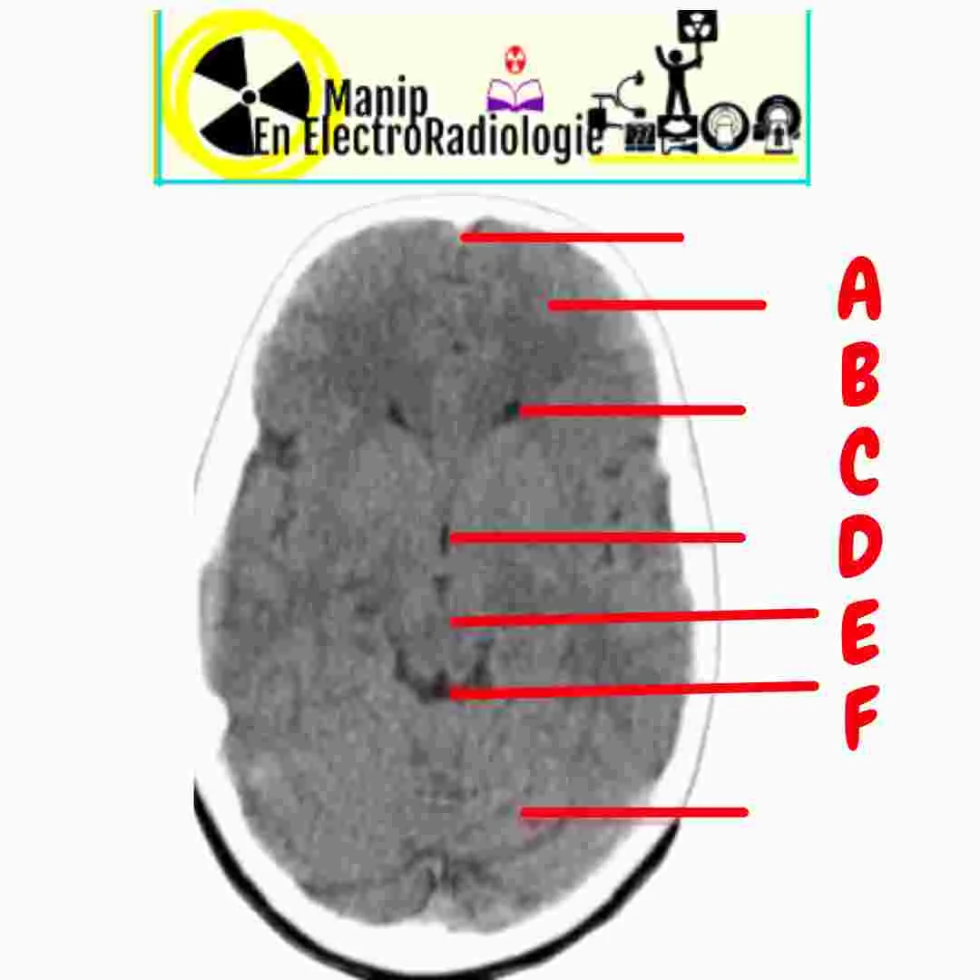 Structures anatomiques vues du tdm cérébral normal au niveau  du cerveau