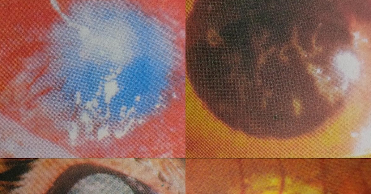 Ocular Complications and Side Effects of Topical Steroid Eye Drops