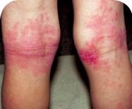 epimax makes eczema worse