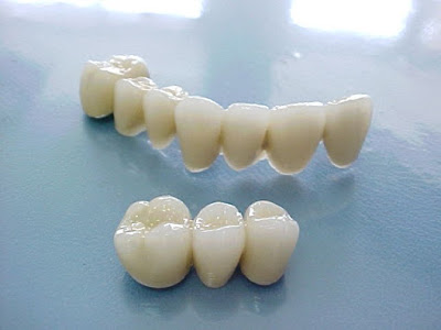 Có nên trồng răng sứ titan không? 