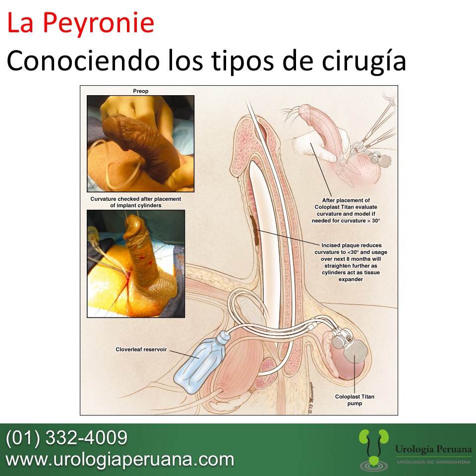 El aumento del pene por el masaje del ejercicio