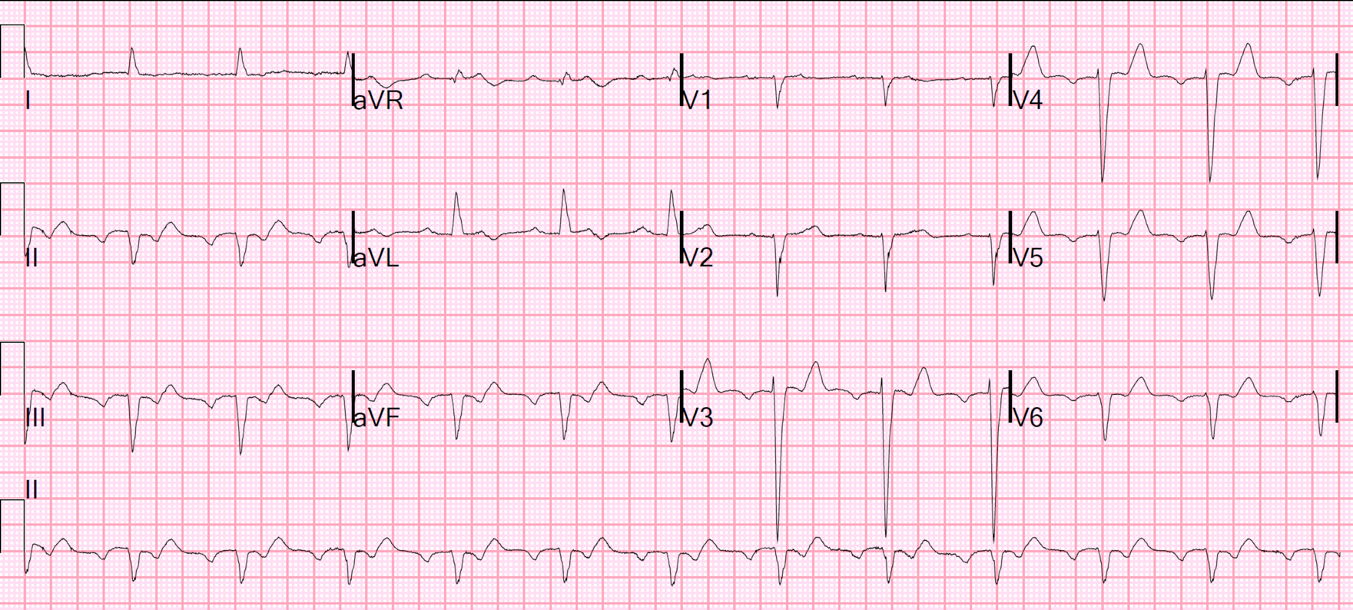 Flutter in chest with cough qrgulu