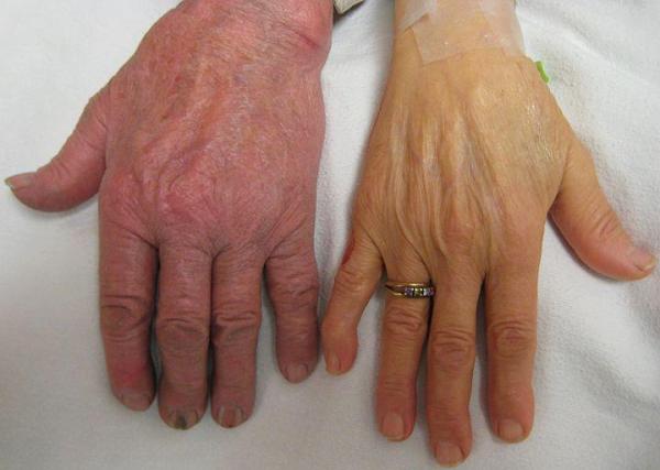 hemochromatosis pictures #10