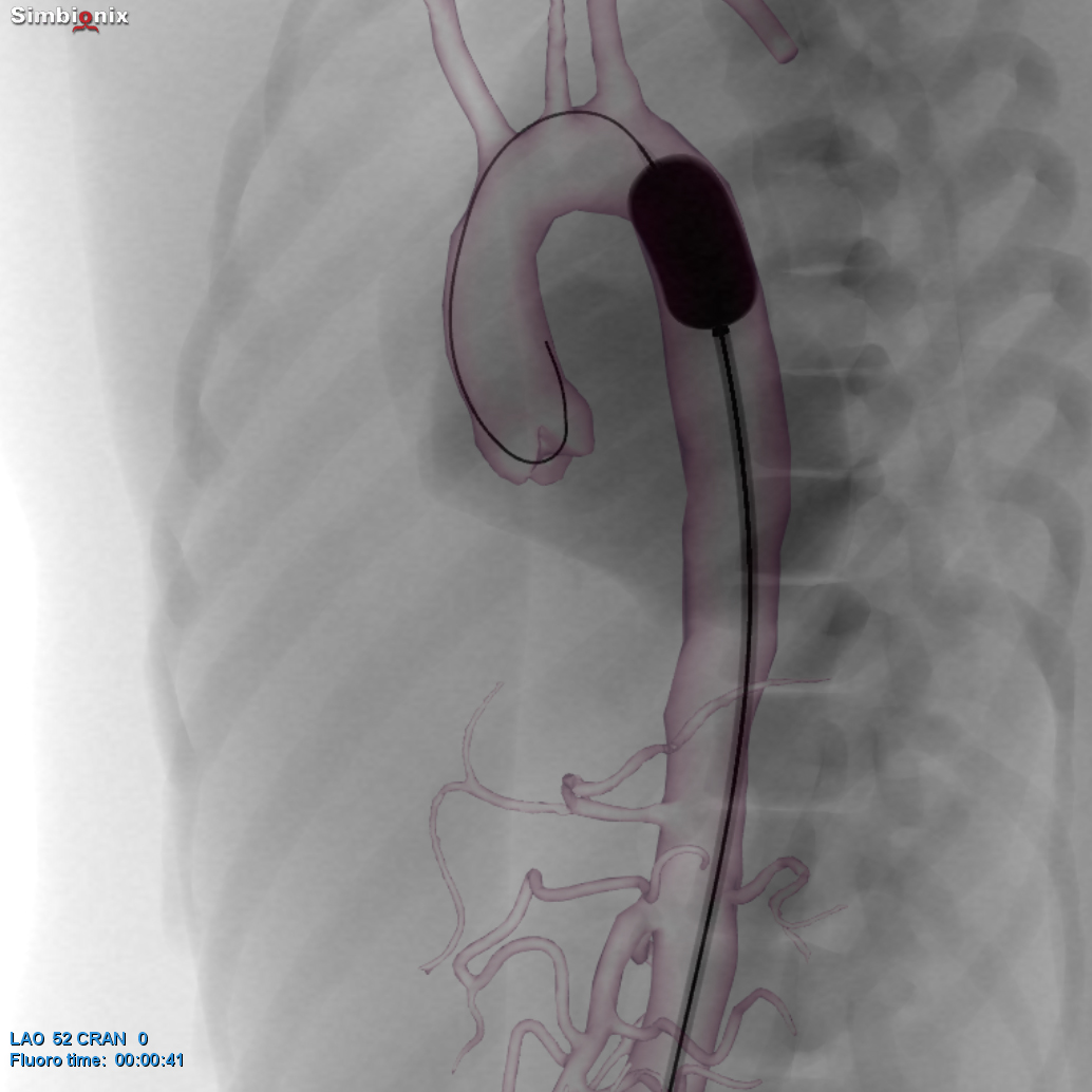 Resuscitative Endovascular Balloon Occlusion of the Aorta (REBOA)? by