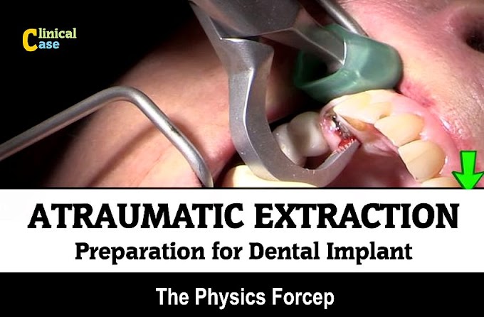EXODONTICS: Atraumatic Extraction - Preparation for Dental Implant