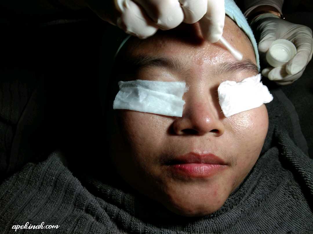 Buat Rawatan OxyPeel C Untuk Merawat Parut Di Dr Medispa & Wellness Buat Rawatan OxyPeel C Untuk Merawat Parut Di Dr Medispa & Wellness