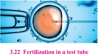 IVF technique
