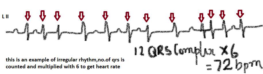 heart rate calculation in ecg for irregular rhythms