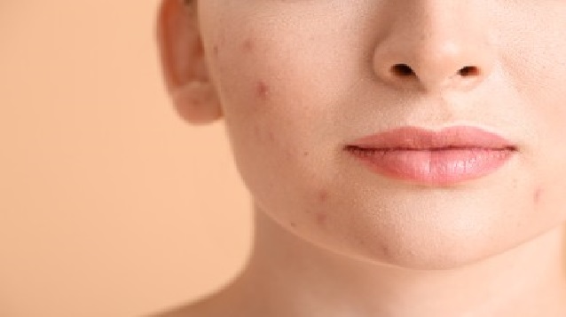 acne disease