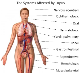 Penyakit Lupus : Ciri dan Gejala Penyakit Lupus