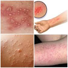 Bintik Air di Telapak Tangan - Penyebab, Cara Meng by jualobatherbal on