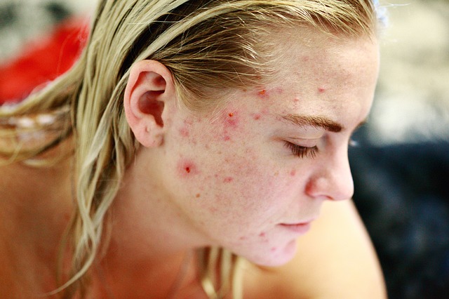 Natural Ways to Cure Acne - Health and Fitness