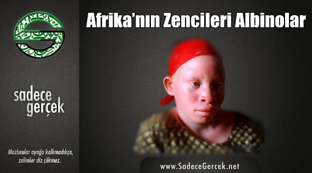 Afrika’nın zencileri Albinolar