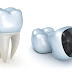 Bị vỡ răng hàm làm sao khắc phục nhanh nhất ?