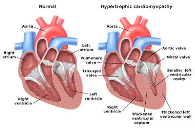 Kardiomiopati Hipertrofik