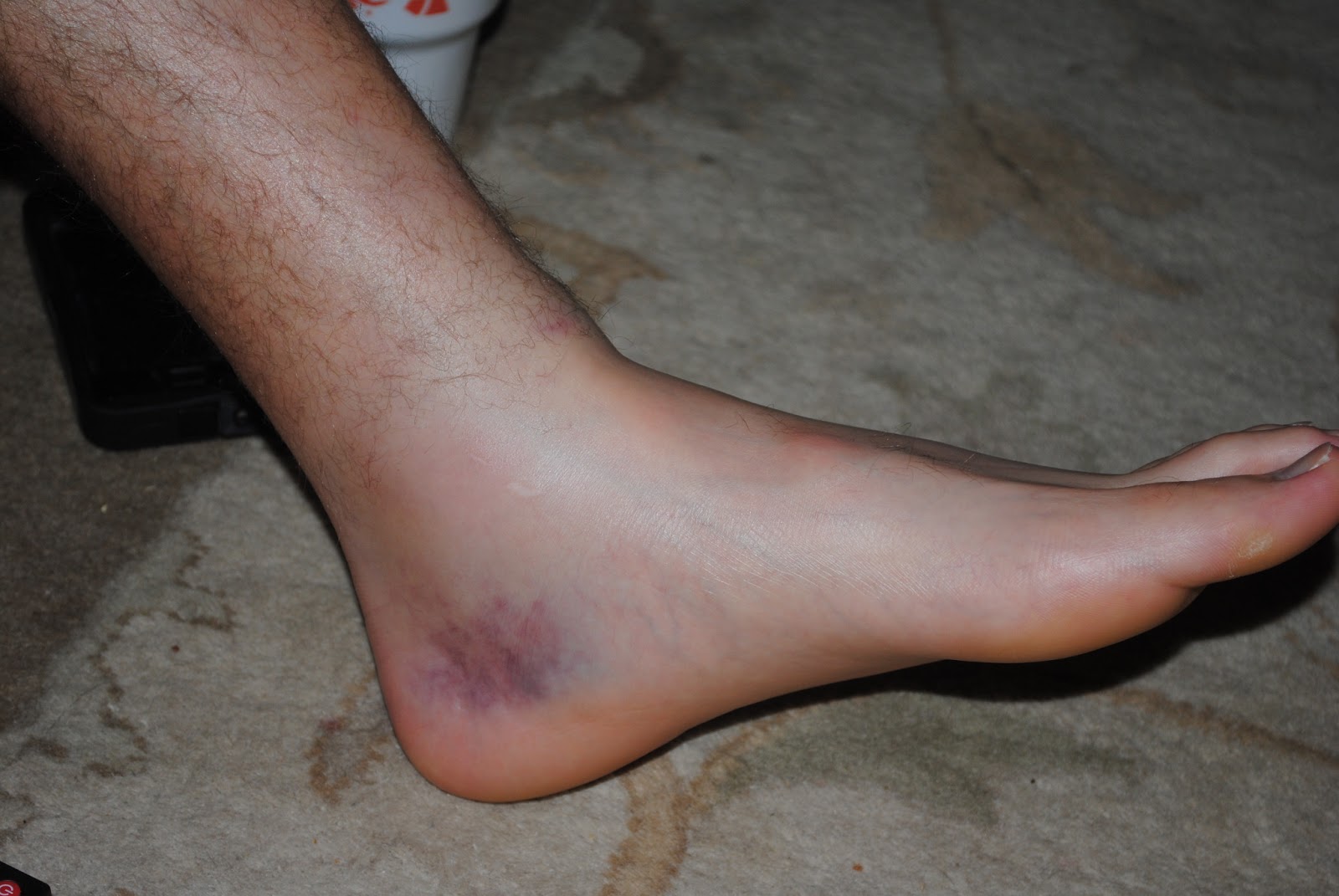 High Ankle Sprain