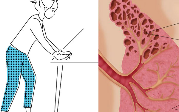 هل يسبب ارتجاع المريء اسباب الخرس والاختناق وعلاجه