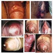 Sipilis Sipilis