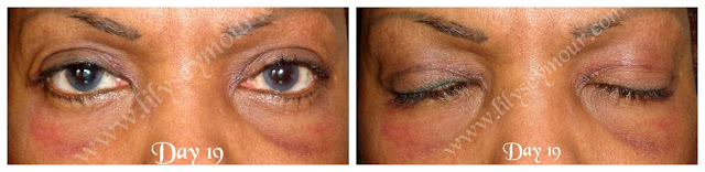 African American Ethnic Blepharoplasty (Eyelid Surgery) Day 17 - Day 20
