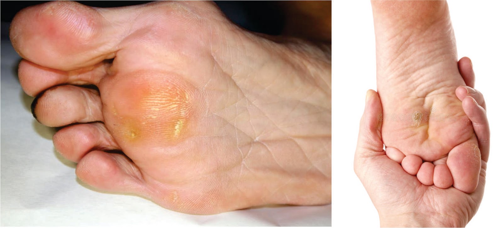 Como Tratar Heloma, Calo ou Calosidade Plantar Como Cuidar dos Pés Como Tratar Heloma, Calo ou Calosidade Plantar Como Cuidar dos Pés