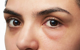  Do you see dark circles under your eyes?