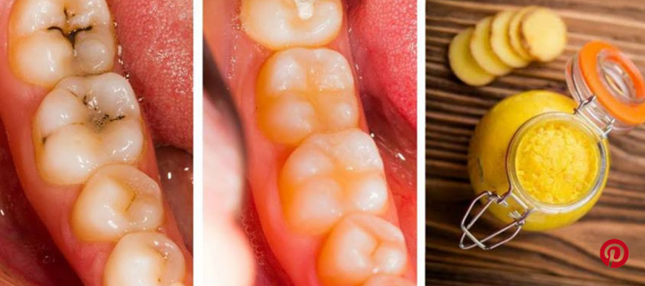 How To Treat Dental Caries Naturally