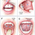 Les signes du cancer de la bouche, les symptômes, et sa prévention
